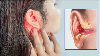 ear infection का मिनटों में होगा इलाज  एक्सपर्ट ने किया घरेलू नुस्खे का खुलासा