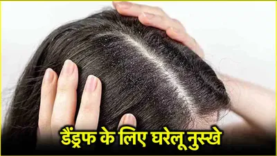 dandruff home remedies  जिद्दी डैंड्रफ भगाएं  ये 7 दमदार तरीके अपनाएं