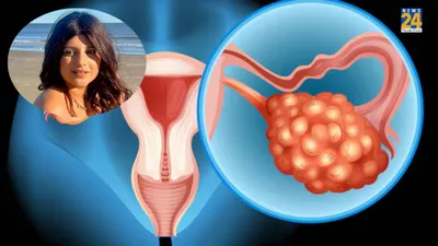 फेमस इन्फ्लुएंसर की ovarian cancer से मौत  ये हैं इसके 6 शुरुआती संकेत  जानें कैसे करें बचाव
