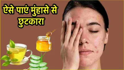 skin care tips  क्या आप भी हैं मुंहासे से परेशान और चुटकियों में पाना चाहते हैं राहत  अपनाएं ये 5 घरेलू नुस्खे  