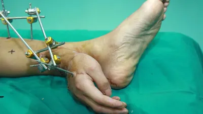 एक्‍सीडेंट में कट गया था हाथ  डॉक्‍टरों ने पैरों से जोड़ा  जानें आख‍िर क्‍यों क‍िया ये  कमाल 