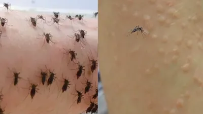 5000 मच्छरों से खुद को रोज कटवाता है ये शख्स  जानें इसके पीछे की चौकाने वाली वजह