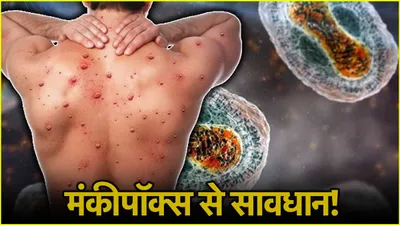 mpox cases  कांगो में एमपॉक्स से मरने वालों की संख्या 570 पहुंची  वैक्सीन के इंतजार में देश