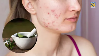 जिद्दी मुंहासे हटने का नाम नहीं ले रहे हैं  तो अपनाएं ये 5 घरेलू नुस्खे  pimples फट से गायब