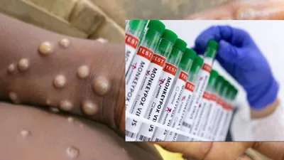 डरा रहा monkeypox का घातक स्ट्रेन clade 1  अब यह सबसे कारगर दवा भी बेअसर