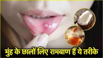 mouth ulcers  क्या आप भी हैं मुंह के छालों से परेशान  अपनाएं ये 3 घरेलू उपाय