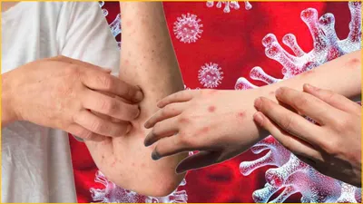 mpox alert  देश में एमपॉक्स का पहला संदिग्ध  हेल्थ मिनिस्ट्री ने राज्यों के लिए जारी की एडवाइजरी