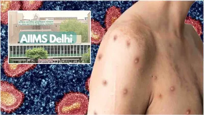 mpox के संदिग्ध मरीज की aiims दिल्ली में दस्तक  जानें जांच रिपोर्ट में क्या आया सामने 