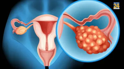 ओवेरियन कैंसर की ग्रोथ में हार्मोन कैसे प्रभावित करते हैं 
