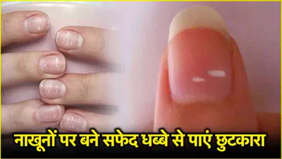 white spots on nails  नाखूनों पर सफेद धब्बे बीमारी का संकेत  इन घरेलू उपायों से पाएं छुटकारा