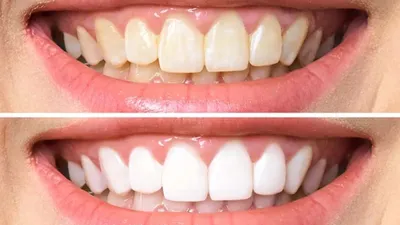 teeth brightening  पीले दांतों से हमेशा हमेशा के लिए छुटकारा दिलाएगी यह जोड़ी  फॉलो करें सिंपल घरेलू नूस्खा