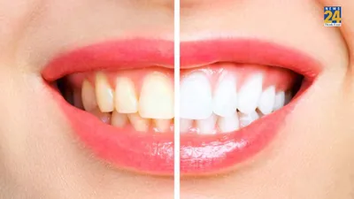 दांतों पर जमा पीलापन जड़ से साफ कर देंगे ये 7 नुस्खे  तुरंत दिखेगा असर
