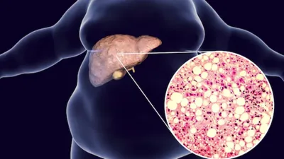 fatty liver treatment  एक चुटकी हल्दी लिवर को तंदुरुस्त करने में है मददगार  जानें अपनाने का तरीका और फायदा