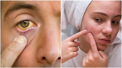 चेहरे पर दिखने वाले ये 5 लक्षण हो सकते हैं गंभीर बीमारी के संकेत