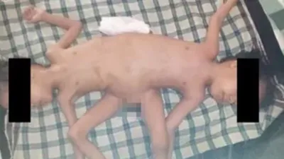एक शरीर  दो मुंह  तीन पैर और चार हाथ  इंडोनेशिया में पैदा हुआ अजीब बच्चा