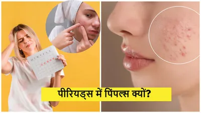 period acne  पीरियड्स के दौरान खो जाता है चेहरे का नूर  एक्सपर्ट से जानें पिंपल्स होने के कारण और बचाव