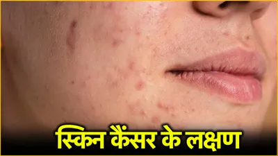 skin cancer  कैंसर का संकेत भी है चेहरे पर लाल धब्बे होना  जानें बचाव के तरीके