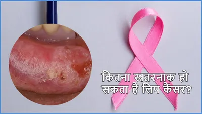 lip cancer symptoms  होंठ कैंसर के 7 संकेतों को न करें इग्नोर  जानें लक्षण  कारण और बचाव