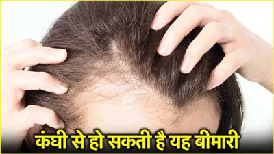 traction alopecia  कहीं आप तो नहीं कर रहे गलत तरह से कंघी  जानें लें  हो सकती है ये बीमारी