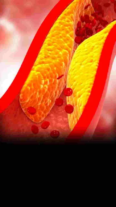 high cholesterol लेवल के 7 संकेत