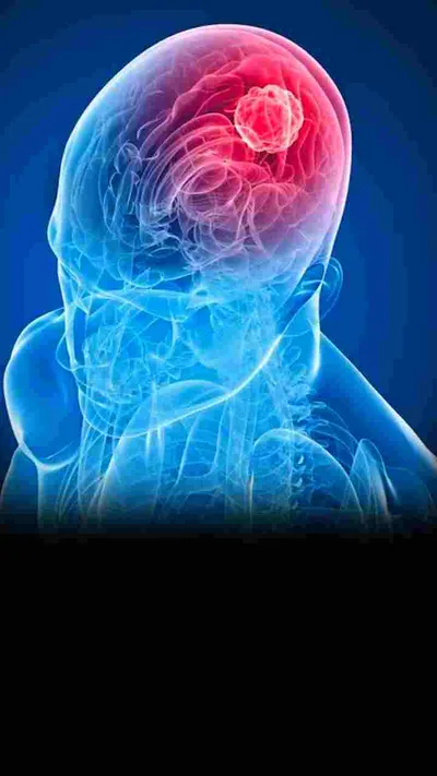 brain tumor के 5 चेतावनी संकेत